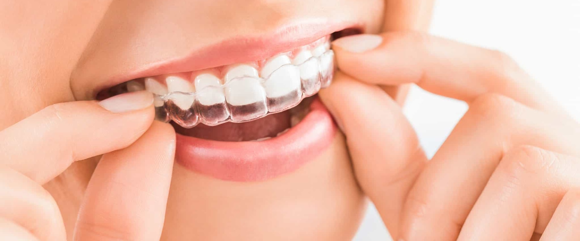 The Benefits Of Invisalign Dentistry A Comprehensive Guide