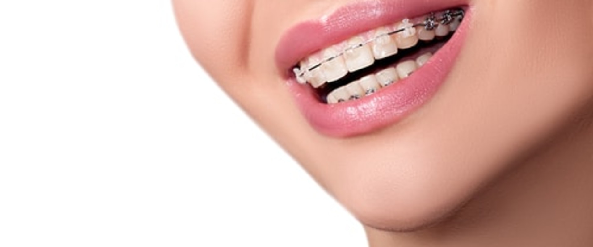 can-i-get-a-second-opinion-from-another-invisalign-dentist