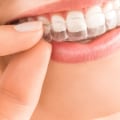 Straighten Your Smile: Finding The Best Invisalign Dentist In Edmonds