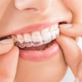 Invisible Braces, Visible Results: Your Guide To The Best Invisalign Dentist In North Kansas City