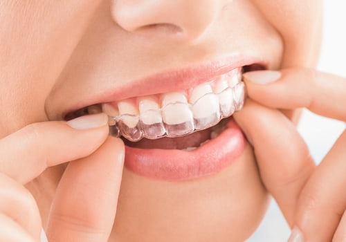 Invisible Braces, Visible Results: Your Guide To The Best Invisalign Dentist In North Kansas City